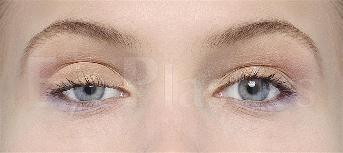 Before and after image of ptosis correction surgery